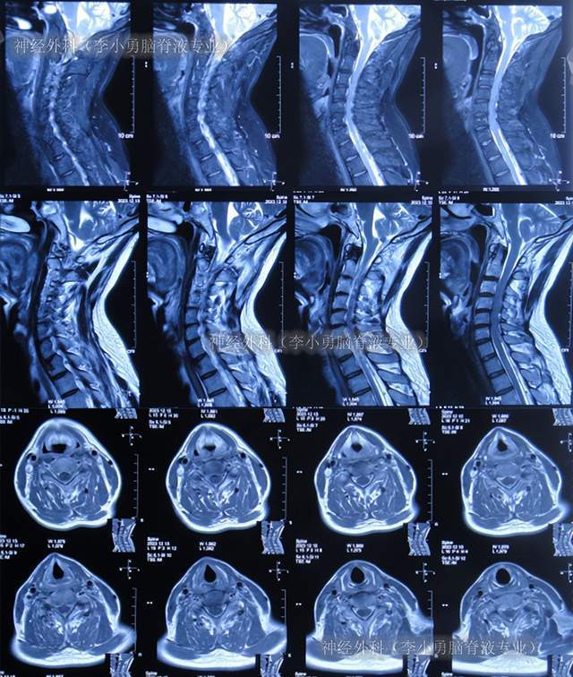 图-33:2023年12月18日颈髓核磁出院后8个月即2024年1月,来院复查:身体