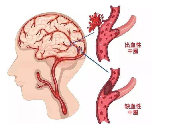 为什么会得脑梗图片