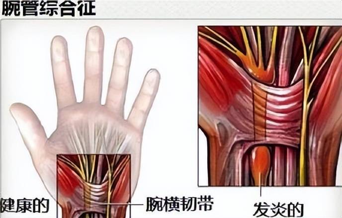 腕伸肌腱鞘炎图片