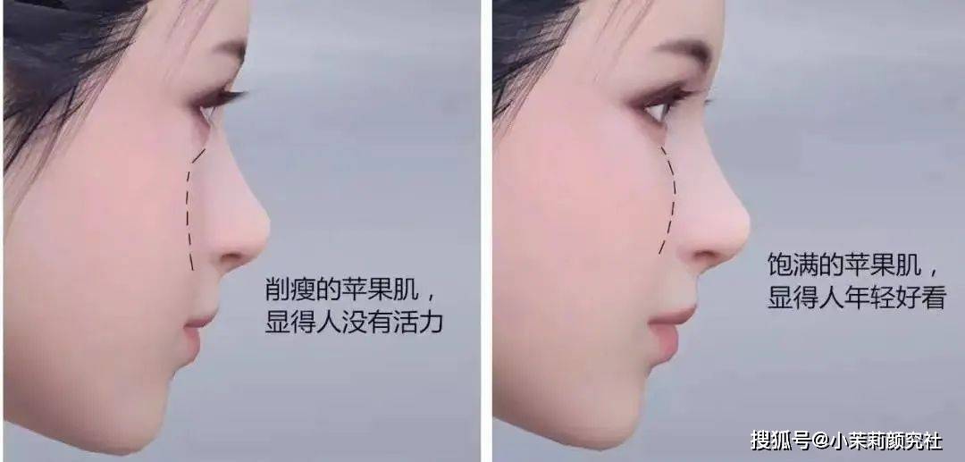 先看看你的苹果肌垮了吗?_组织_面部