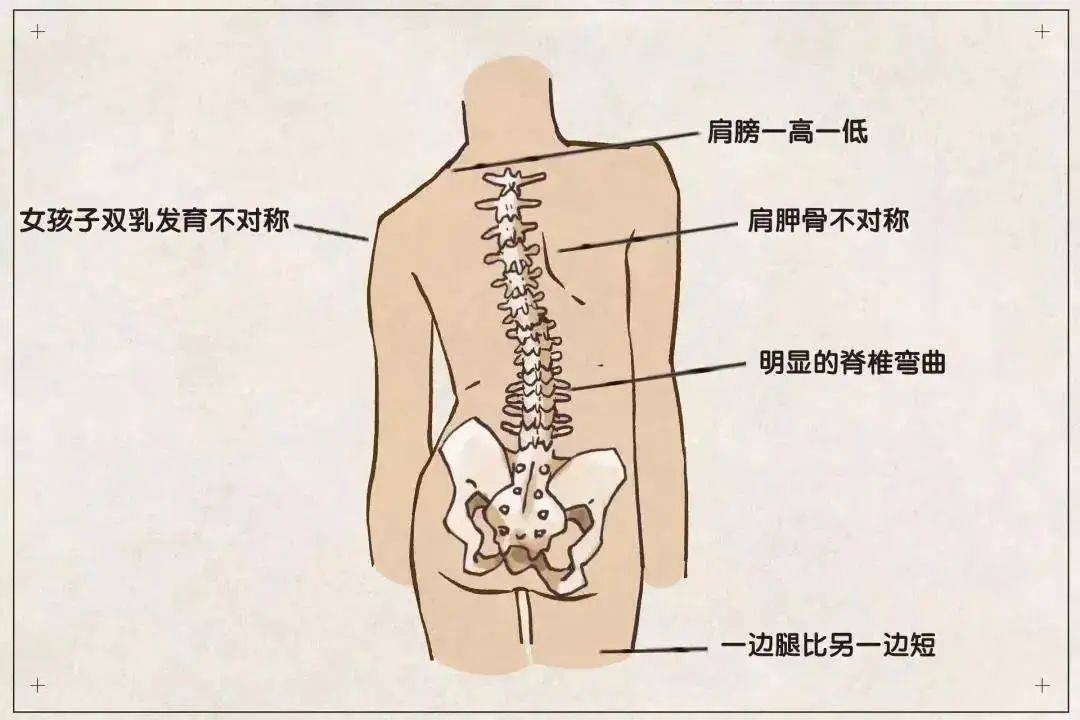 脊柱侧弯和驼背区别图图片