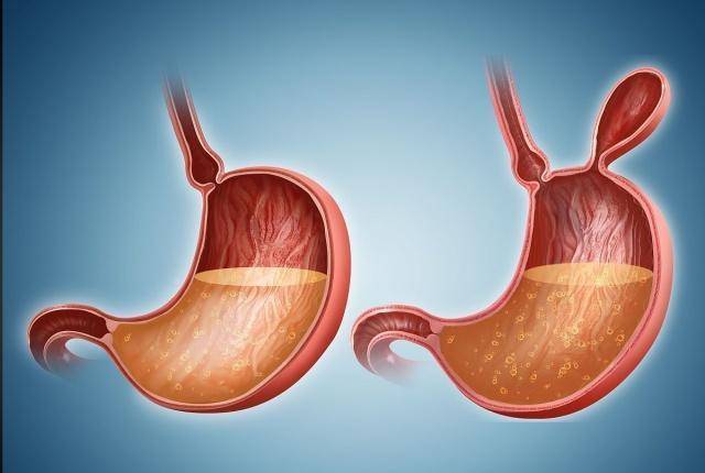 做多了对胃有伤害吗?医生道出真相_患者_进行_症状