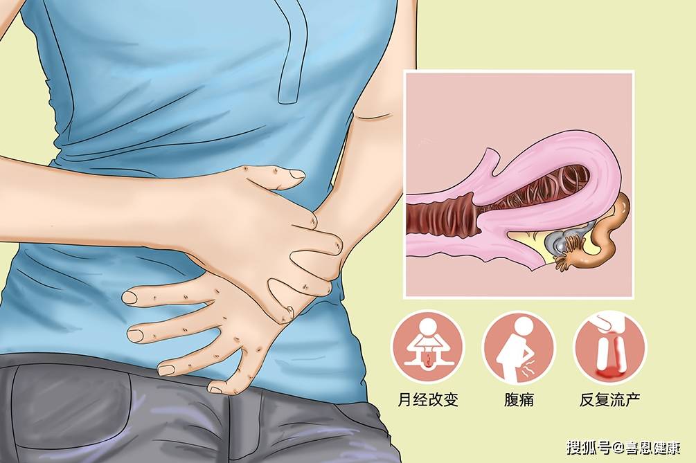 喜得好孕:女性多发的子宫内膜息肉,是怎么回事?_影响