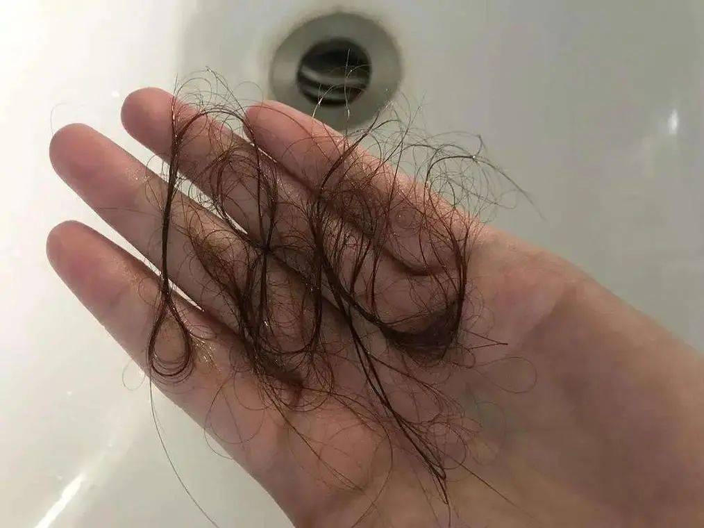 难道是头发不爱你了吗?