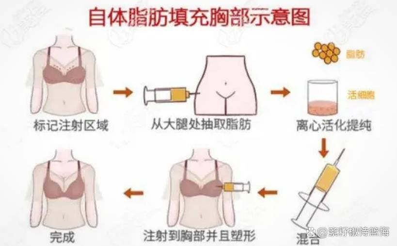 塞翁失马焉知祸福自体填充脂肪的利弊有什么,脂肪填充