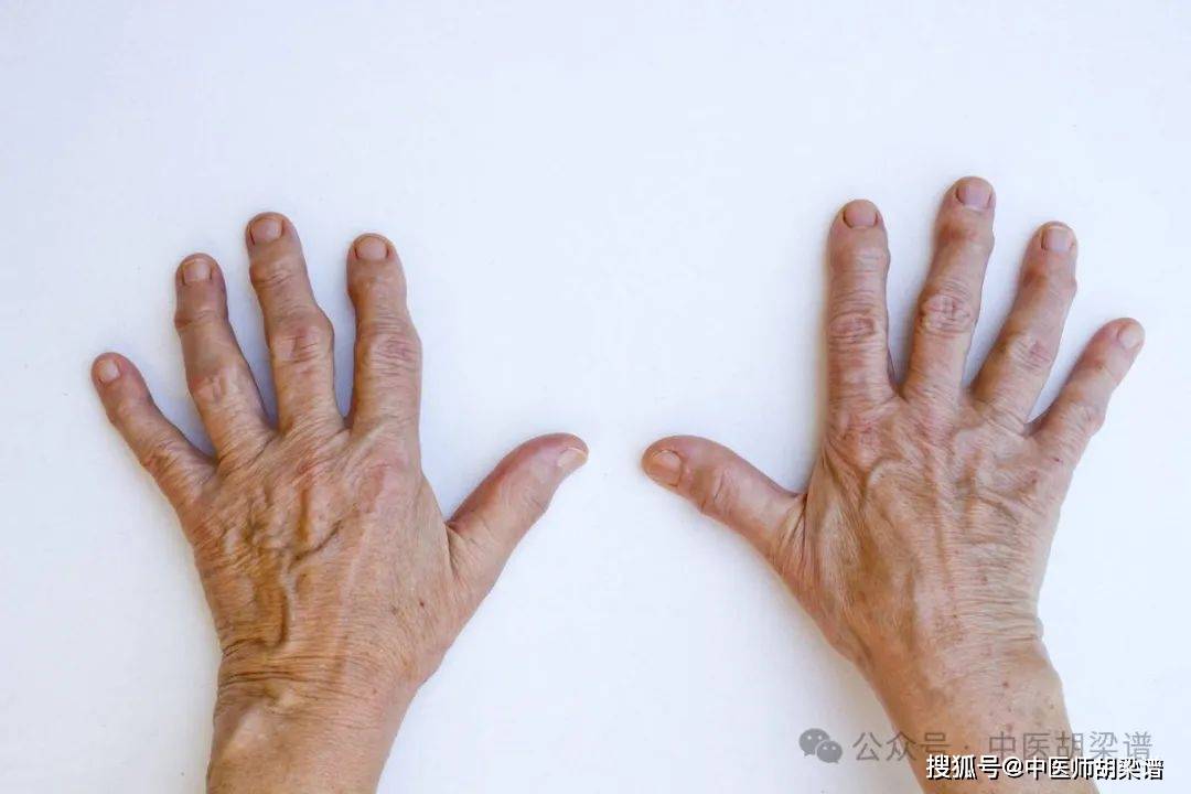 晨僵关节活动不利,有可能是类风湿症状,应及早治疗