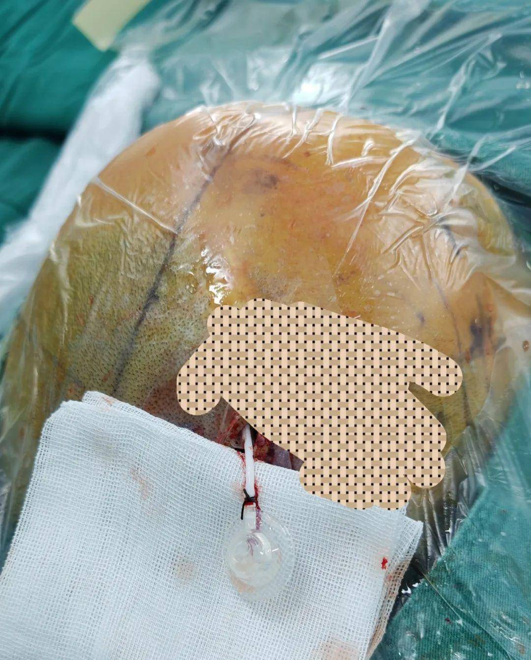 乾县人民医院首次开展颅咽管瘤伴囊肿ommaya囊植入术_患者_服务_进行