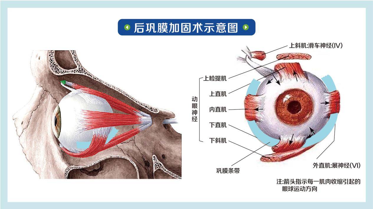 國內(nèi)做后鞏膜加固術(shù)好的醫(yī)生排名2025名單