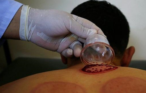 拔罐后颜色重,是体内湿气太重吗?