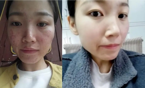 的质地能够迅速深入肌底,然后它配方里含有多种维生素和透明质酸成分