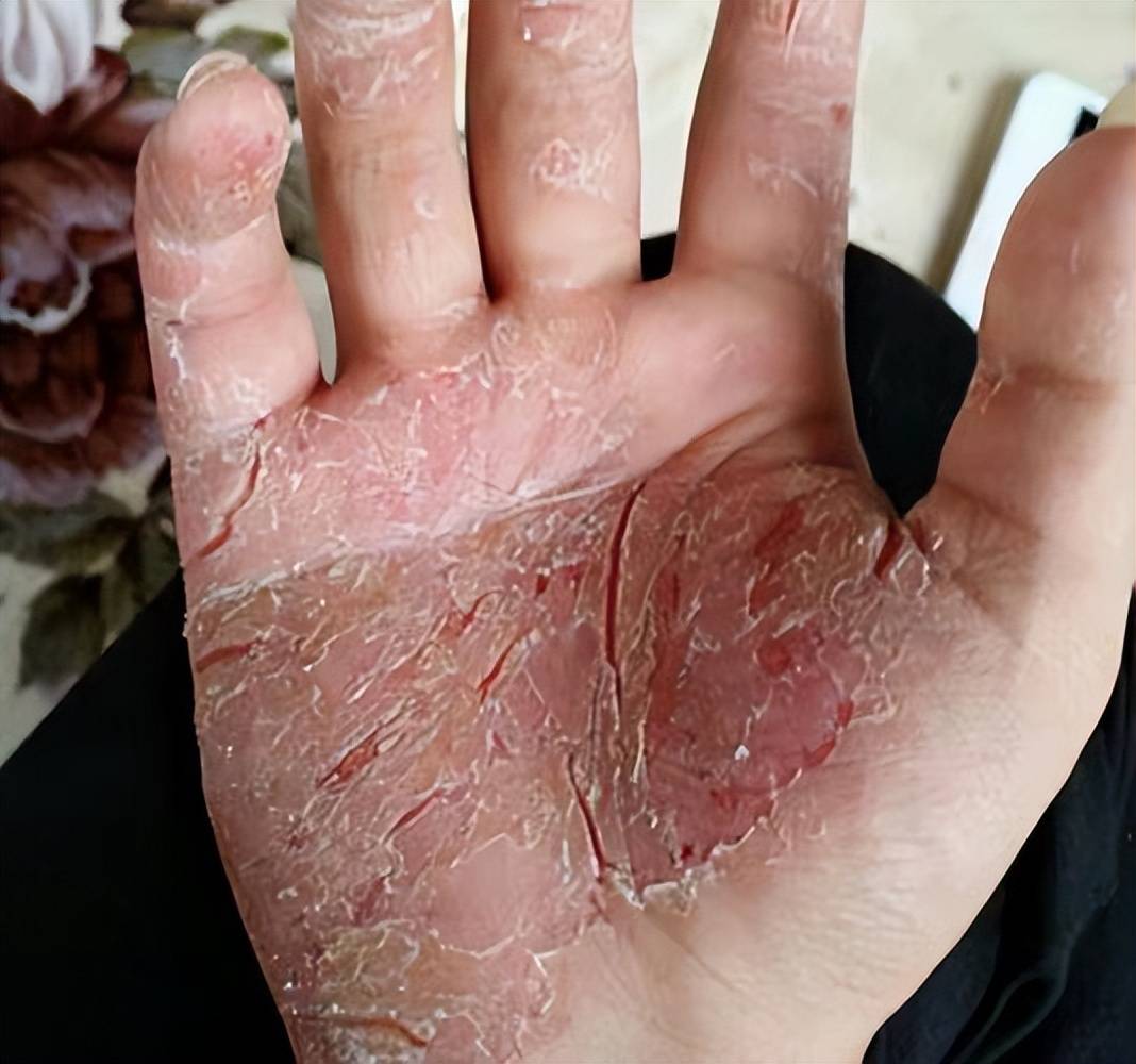 解决手掌干裂别偷懒!按照这个步骤做,本人实测满手裂口全好了!