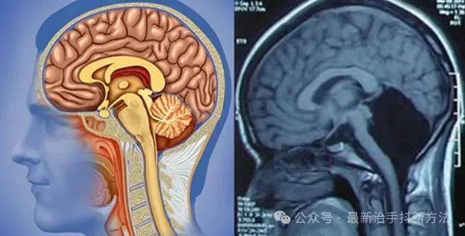 寻找多系统萎缩病情的参差,李艳波主任输出经典疗法