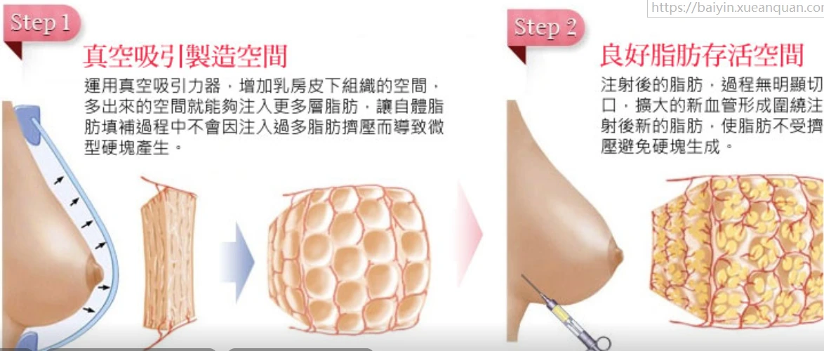 到底哪个好自体脂肪隆胸和假体隆胸哪个好,自体脂肪丰胸缺点是啥_细胞