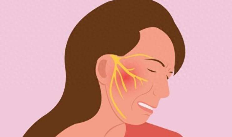 一文带您揭秘"天下第一痛"——三叉神经痛