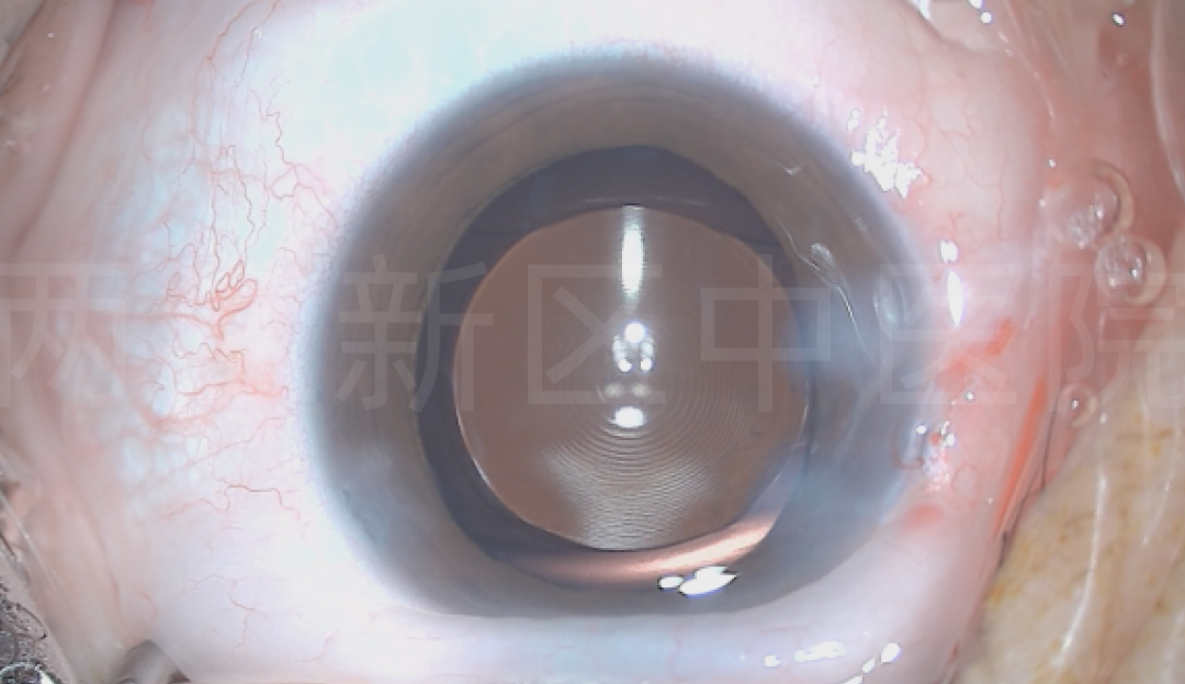 我院成功开展多焦点人工晶体植入术 助患者重现清晰视界