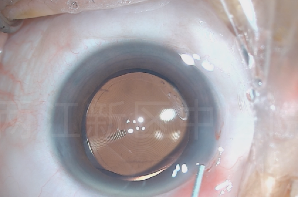 人工晶体表面的特殊设计,使远距离和近距离的图像都能聚焦在视网膜上