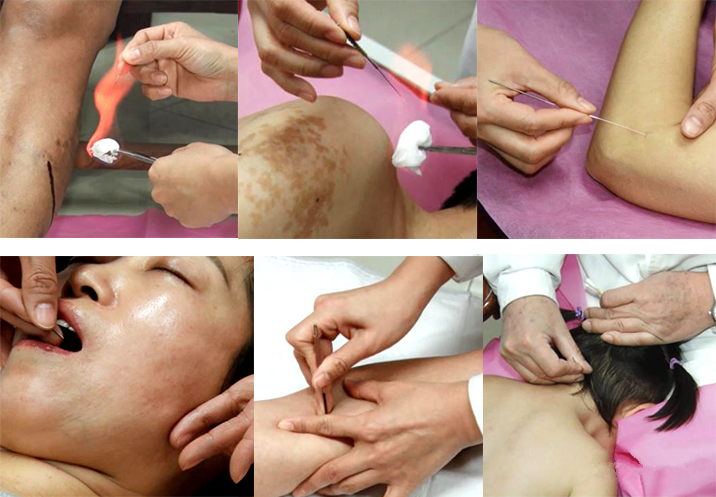 贺普仁贺氏针灸传承贺林 贺小靖 贺伯汉 非遗传承贺氏三通针灸临床