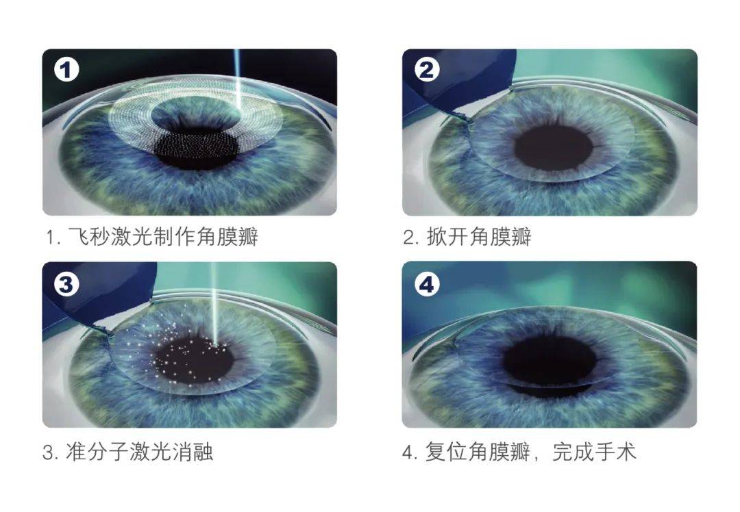 近视激光手术原理图片