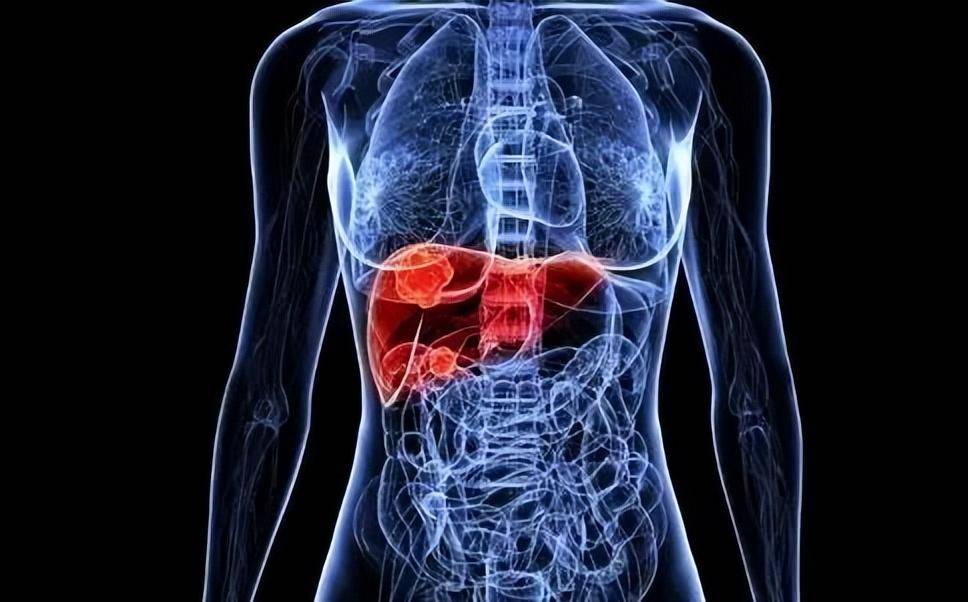 得了肝硬化可以治愈吗?10个临床表现!早发现早治疗!_肝脏_肝功能_疾病