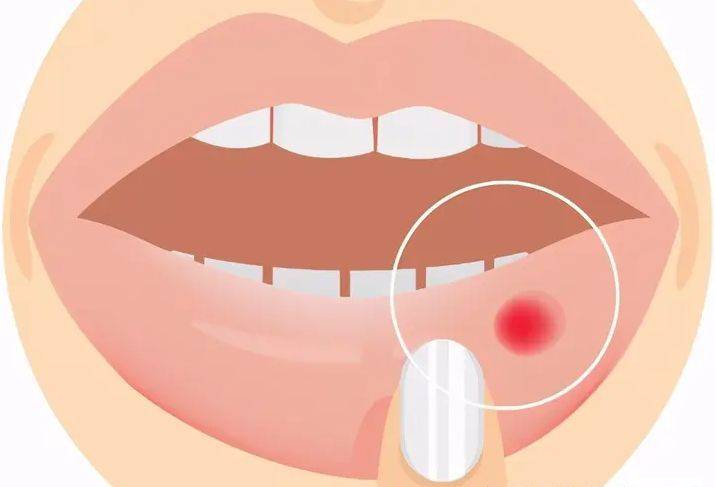 谷医堂谷方益元:春季口腔溃疡的三大预防措施_运动_饮食_增强体质