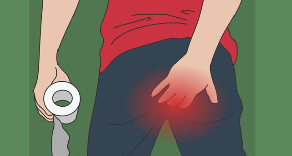 回纳_肛门_内痔