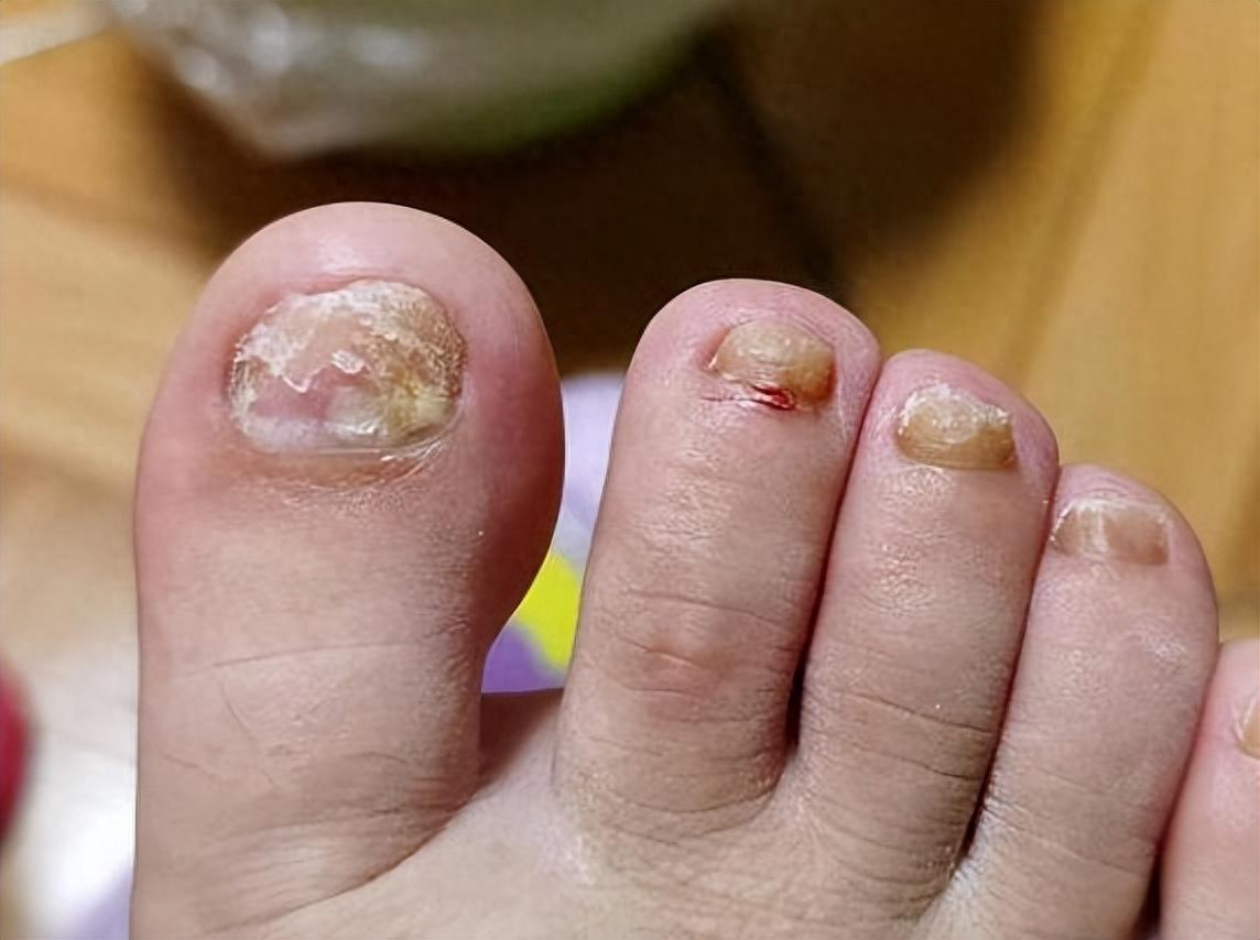 过来人总结的祛灰方法真管用,45天就能摆脱灰指甲!_时间_情况_等上