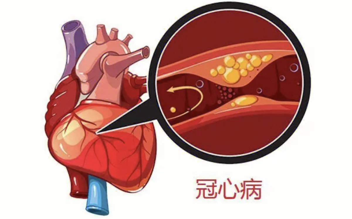 张问渠教授分享冠心病治疗案例:10年不易复发