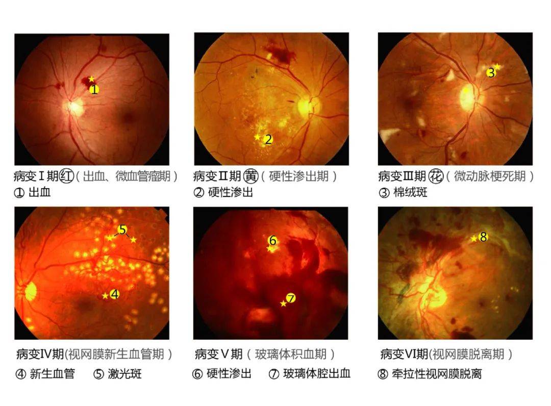 糖尿病是如何导致视网膜病变的?
