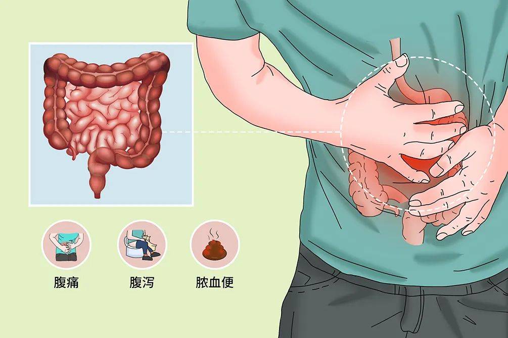 潰瘍性結腸炎是一種影響結腸的慢性疾病.