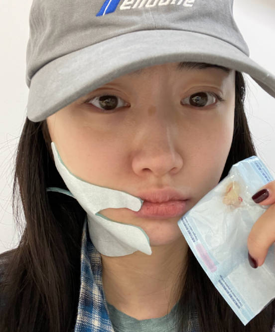景甜晒拔牙后的自拍照,素颜出镜脸部浮肿,网友:像换了个人一样_资源