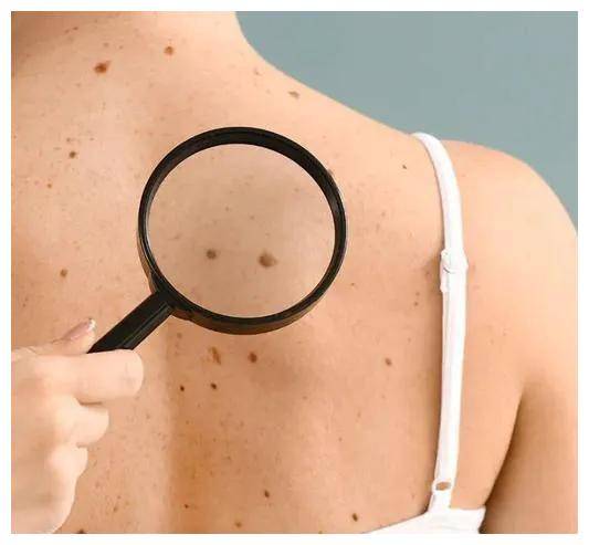 在电影中,李香山可能已经到了黑色素瘤的晚期,即使全力治疗也难以逃脱