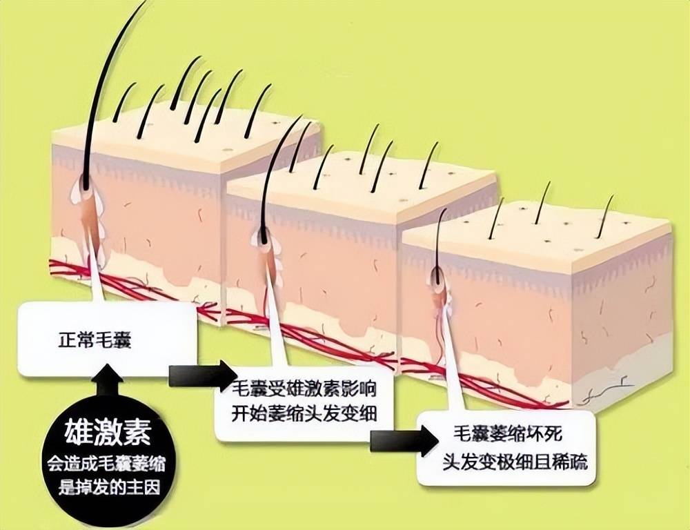 雄激素性脱发的基本原理,主要是雄性激素睾酮在5α还原酶的影响下