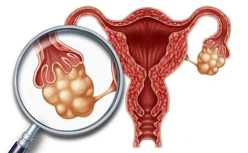 引起宫腔粘连的原因是什么?具体有什么危害呢?_子宫_影响_症状