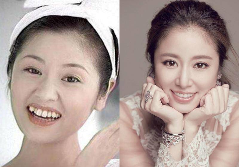 李沁牙齿变白了?《微微一笑很倾城》孟逸然整牙如换脸,颜值飙升