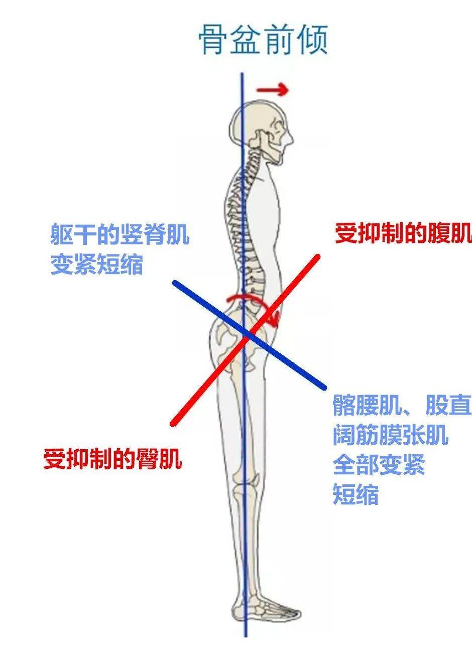 骨盆前倾怎么形成的图片