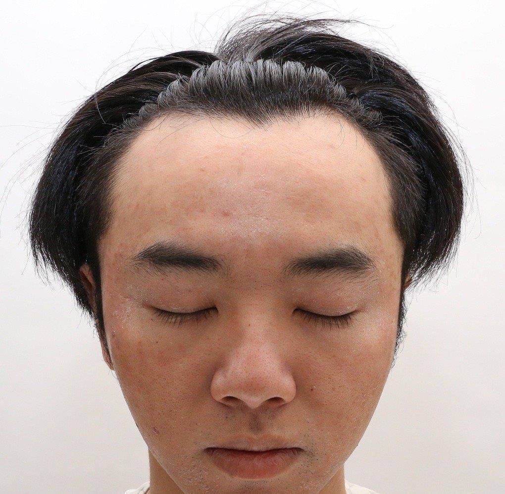 原创网友称华晨宇是自己老公还晒出多张华晨宇植发照片称张碧晨是小三