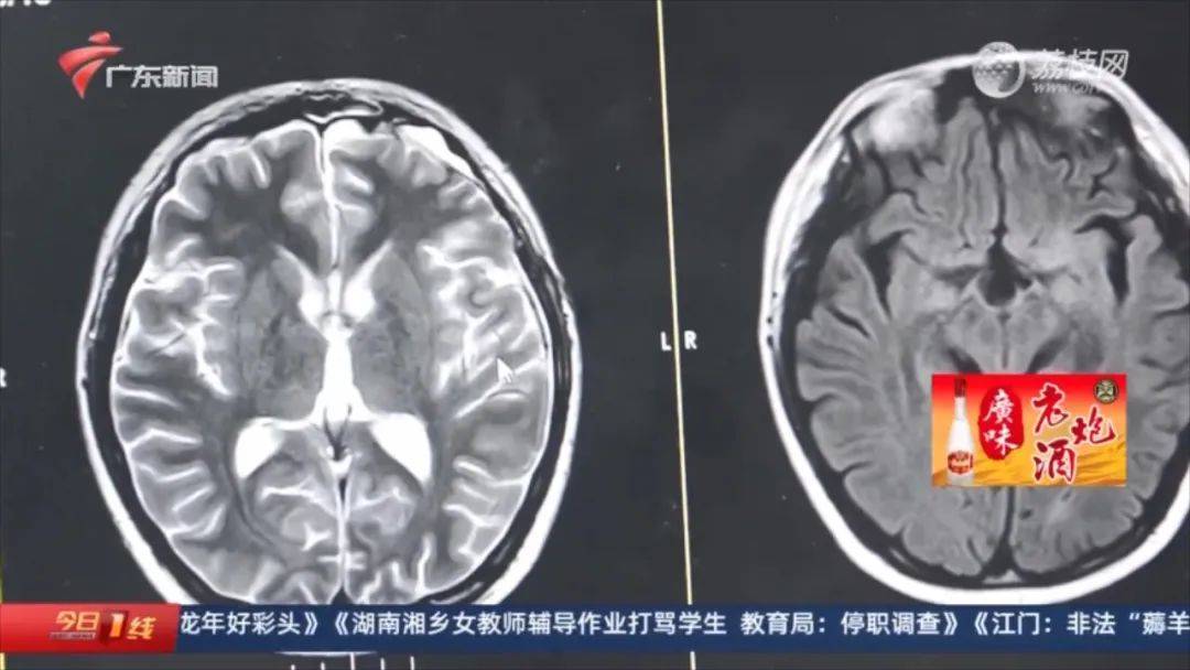 男孩一天喝9升水被查出肿瘤,还伴有异常行为