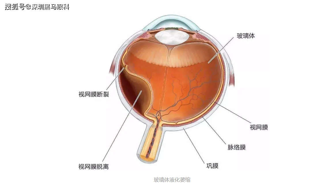 但是随着年龄增长和玻璃体液化的发展,眼内会出现玻璃体与视网膜内界