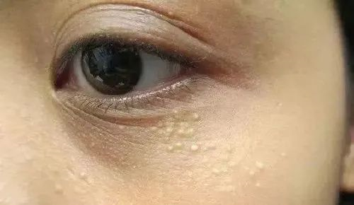 粉刺怎么治疗脸上有粉刺该怎么办临泉治疗粉刺的皮肤医院粉刺怎么消除