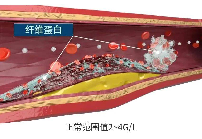 动脉粥样硬化纤维帽图片