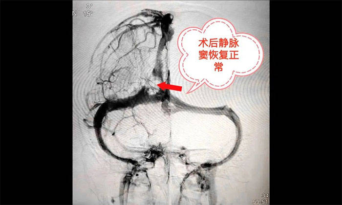 术后,静脉窦顺利再通▲ 出院后,患者赠送锦旗以示感谢脑静脉窦血栓