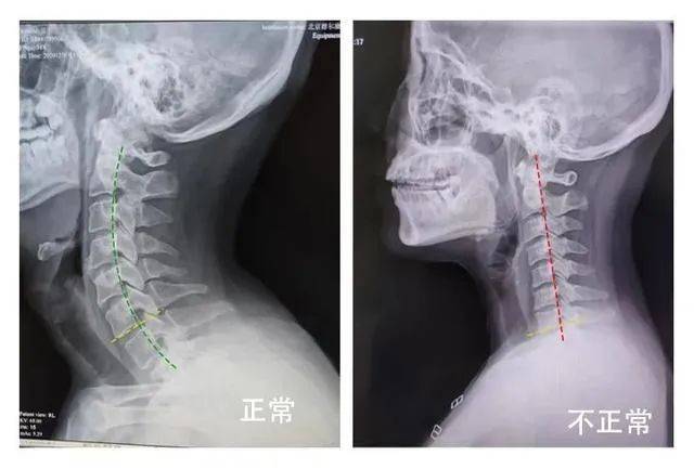 头晕:辨识耳石症,前庭神经炎与颈椎病引起的头晕和恢复手法