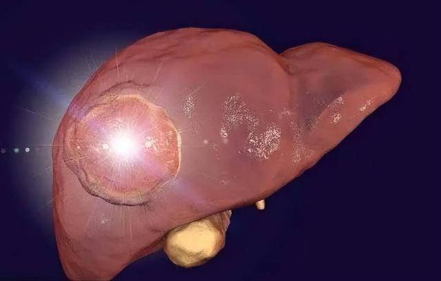 原创35岁男子每天吃猪肝养肝确诊肝硬化医生叹息太过无知