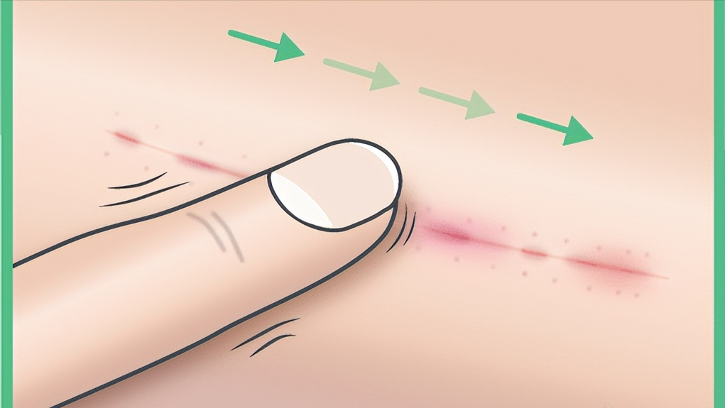 顽固疤痕增生不用激光,每天15分钟,在家轻松祛疤不反弹!