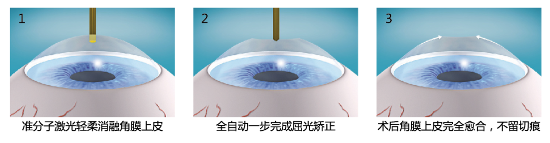 手术_角膜_激光