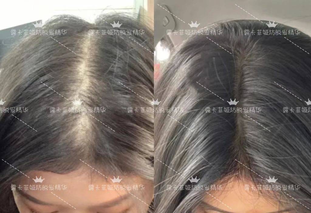 蔓迪米诺地尔能很好的促生发,可以说涂哪里长哪里!