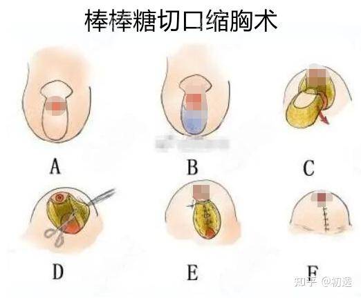 乳房_医生_乳晕