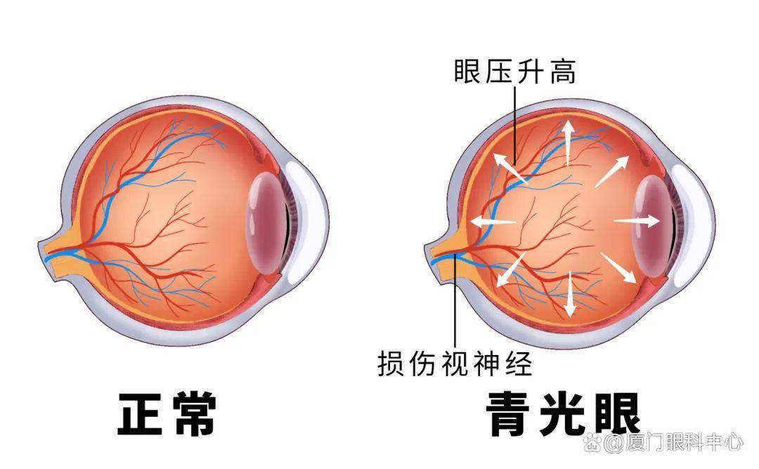 还在关灯玩手机了小心青光眼记性发作医生紧急提醒