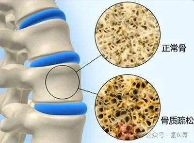 双迪富氢如何正确预防沉默的杀手糖尿病性骨质疏松