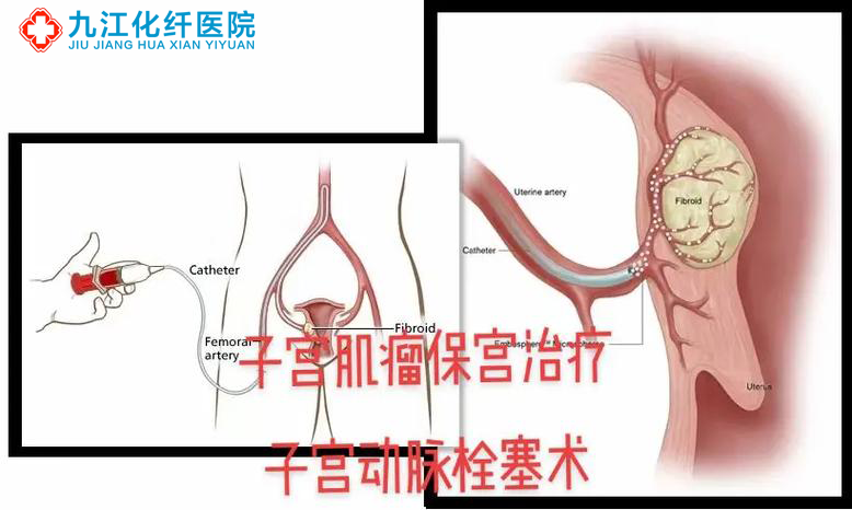 有医靠九江有家医院成功完成一例高难度子宫肌瘤剔除术百姓故事
